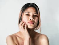 Asian woman suffering from Skin allergy from Cosmetic and Make up making her skin all over the body red itchy and painful. -vista.com