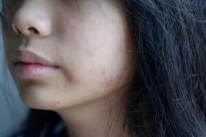 Rash face woman allergic to cosmetics food allergy or air allergy - vista.com